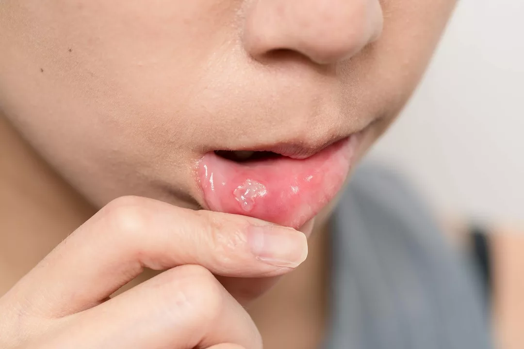 Acyclovir for Herpetic Gingivostomatitis: Easing Oral Pain