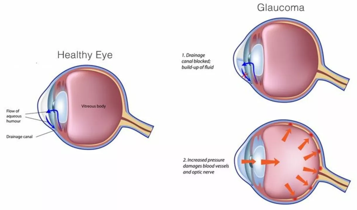 Sulfasalazine and Eye Health: Potential Risks and Precautions